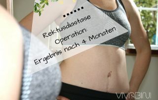 Ergebnis nach Rektusdiastase Operation und Bauchdeckenstraffung