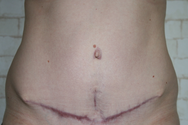 Narbe Bauch vier Monate nach Rektusdiastase OP und Bauchdeckenstraffung